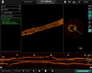 3D imaging technology - Stent Placement