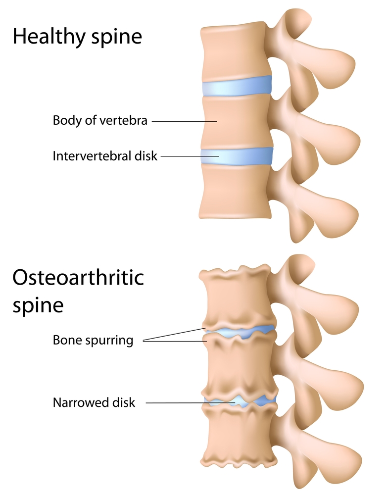 Innovative Vertebral Augmentation Device To Help With Osteoporosis